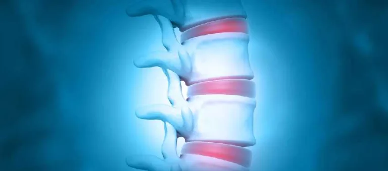 Bulging Disc